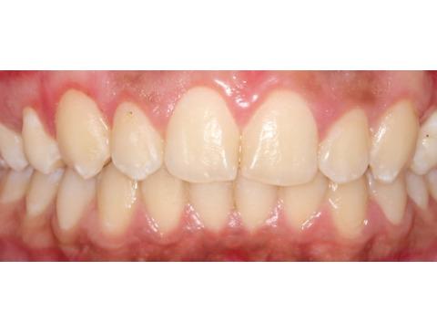 Paciente clase II con sobrepase horizontal aumentado