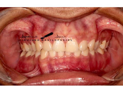 Corrección de fractura mandibular
