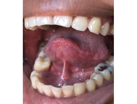 Cirugía de lipoma Bucal